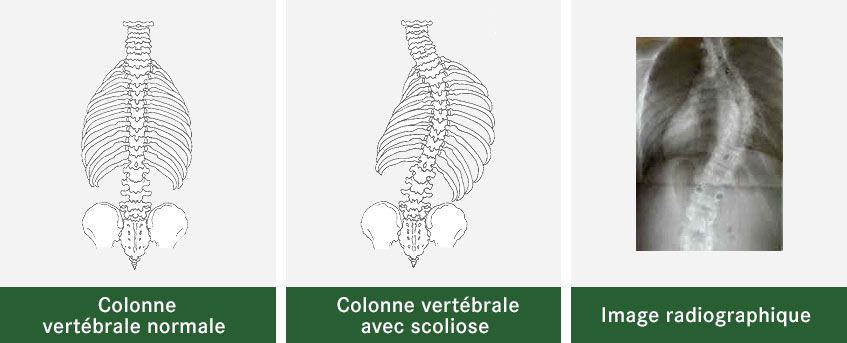 Colonne vertébrale normale comparée à une colonne vertébrale atteinte de scoliose