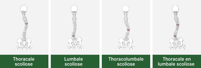 Scoliose thoracique, lombaire, thoraco-lombaire